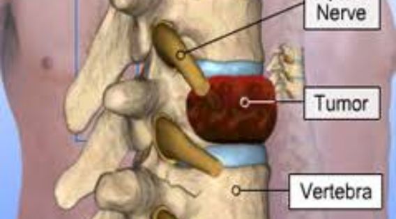 Spine Tumor Surgery in India: Consult Top Spine Neurosurgeon in Kolkata, India