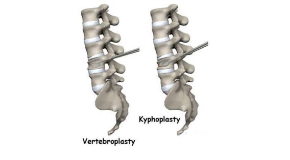 Vertebroplasty and Kyphoplasty Recovery Time in the Elderly: Consult a Top Spine Surgeon in India, Kolkata