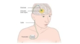 Brain Pacemaker India: Deep Brain Stimulation (DBS) Surgery in Kolkata