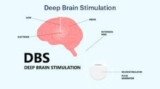 DBS for Parkinsons’ India: Deep Brain Stimulation Treatment in Kolkata, India