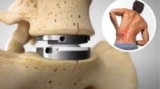 Disc Replacement India: DBS Surgery in Kolkata, India