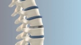 Disc Replacement Surgery in India: Contact the Best Cervical Spine Surgeon in India