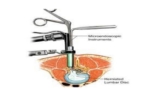 Minimally Invasive Discectomy: A Revolutionary Procedure for Herniated Discs