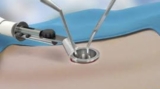 Minimally Invasive Spine Surgery in India for Faster Recovery