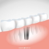 Narrow Dental Implants Market Growth Prediction 2019 (Straumann,  Danaher,  Dentsply and   Zimmer Biomet)