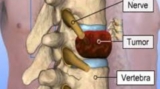 Spine Tumor Surgery in India: Consult Top Spine Neurosurgeon in Kolkata, India