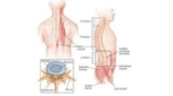 Spine Tumor Treatment in India: Kolkata’s Best Neuro Spine Surgeon