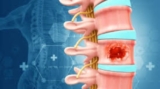Spine Tumors Treatment in India:  Symptoms, Causes, and Risk Factors