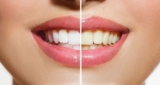 Teeth Whitening In Chandigarh: Achieving a Brighter, Whiter Smile