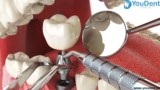 Why Choose Zygomatic Dental Implants: Benefits And Advantages In India