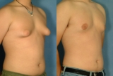 Diet and Exercise After Gynecomastia Surgery: Optimizing Your Results