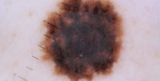 What Makes Acne and Wrinkles Treatment Effective in Tustin, CA?