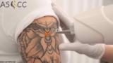 What Is The Best Treatment For Tattoo Removal? | Can Tattoo Be Removed Permanently?